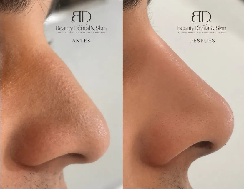 Antes y después 6