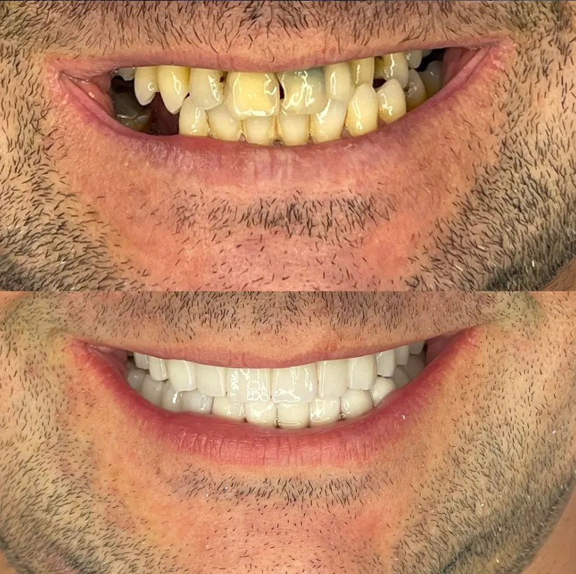 Antes y después 9