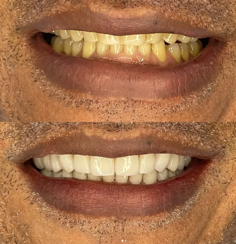 Antes y después 10