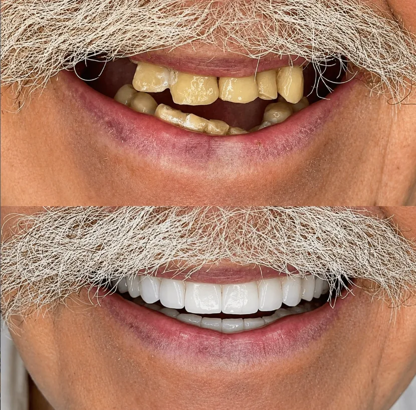 Antes y después 11